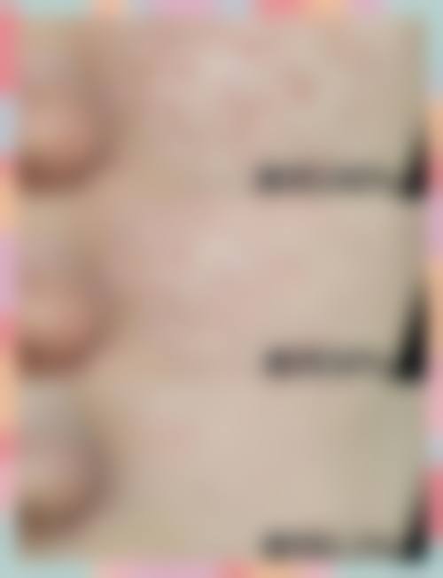 大连爱德丽格医美手针排痘项目的技术优势