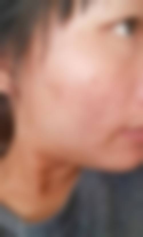 大连爱德丽格医美手针排痘项目的口碑实例