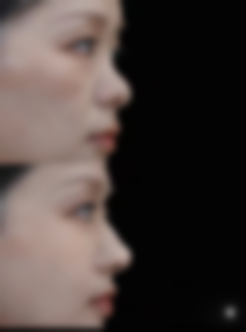 种植头发后多久可以烫头发