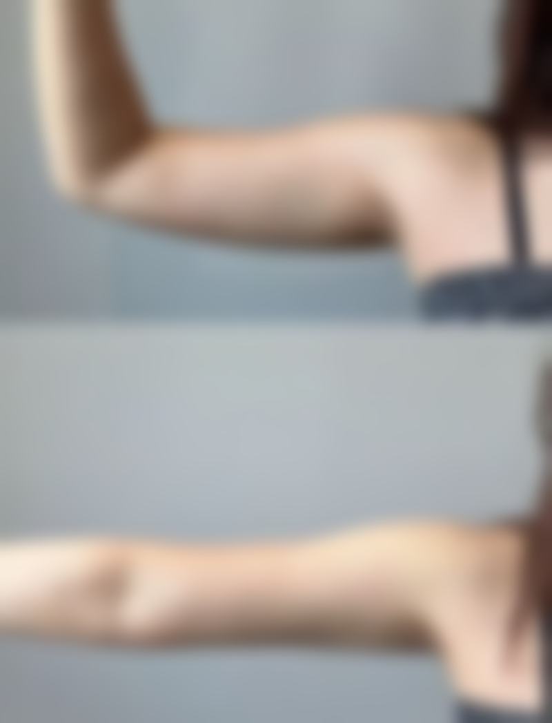 打完瘦脸针能吃感冒冲剂吗