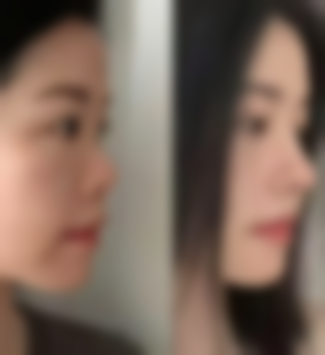 理性对待打除皱针