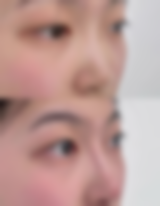 玻尿酸注射方法教程