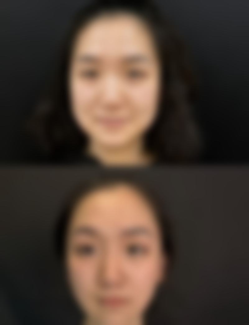 天生圆脸打瘦脸针有用吗？揭秘3大瘦脸针效果真相，让天生圆脸也能拥有明星同款精致小V脸！ 