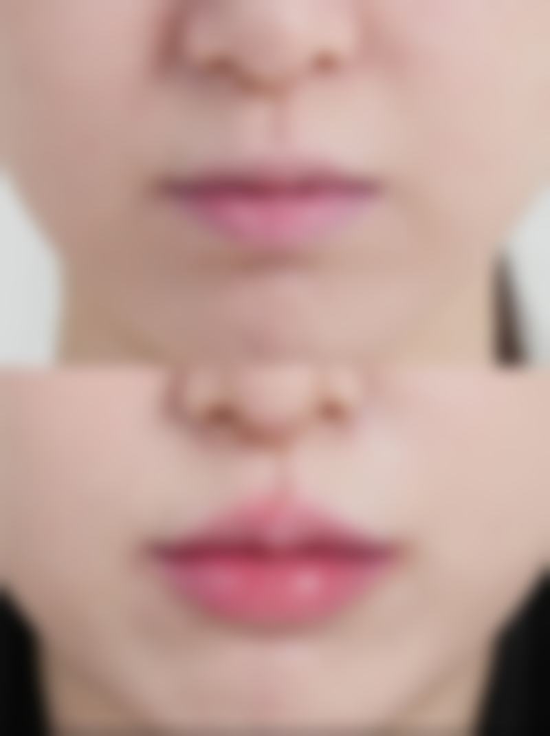 头发种植——解决脱发的有效方法