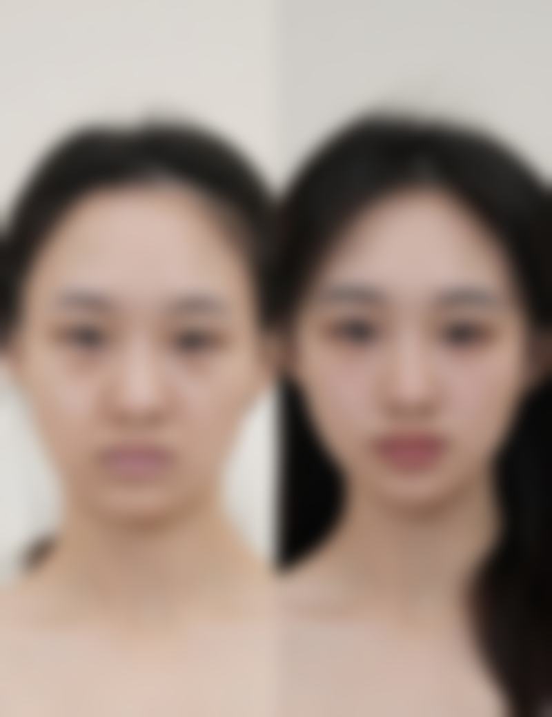 如何缩小嘴巴非整形