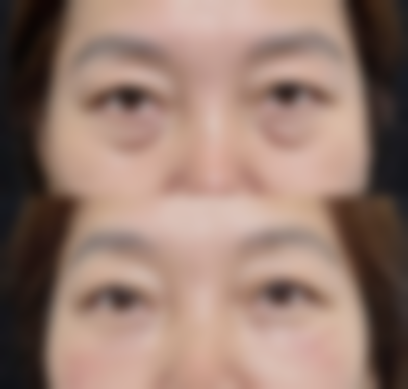 彩毒瘦脸针多久见效