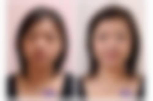 打完瘦脸针可以维持多久？之后有什么