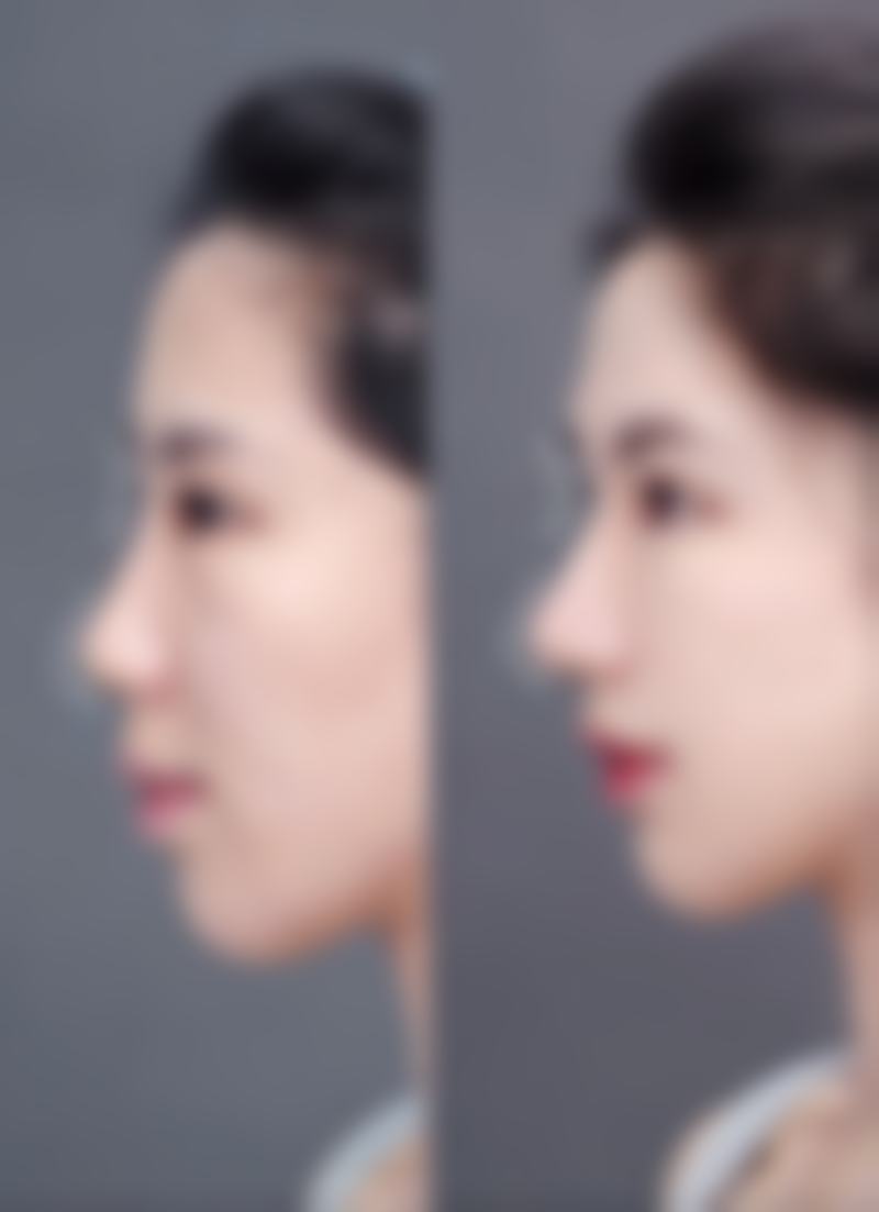 【郑州菲林眼鼻修复中 心参考价格表：】