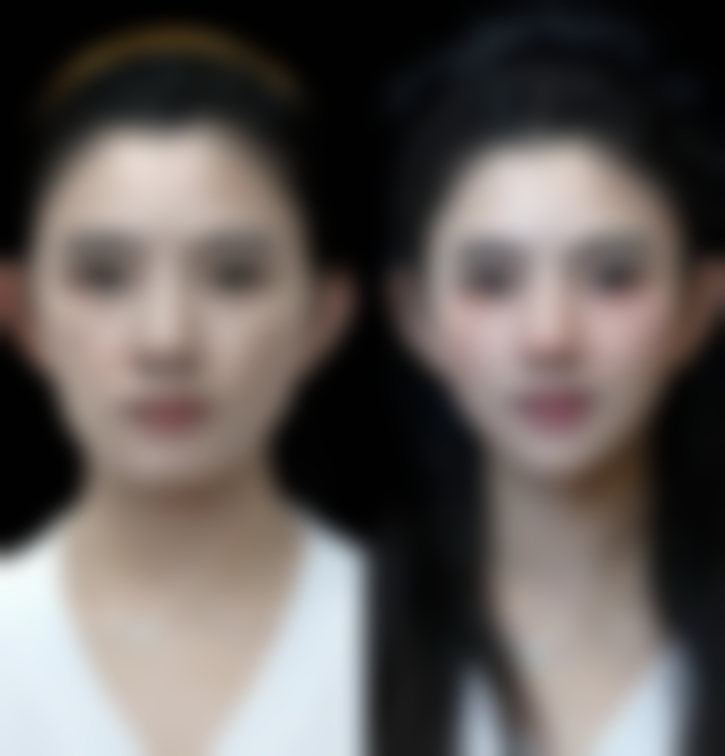 丰唇整形多少钱