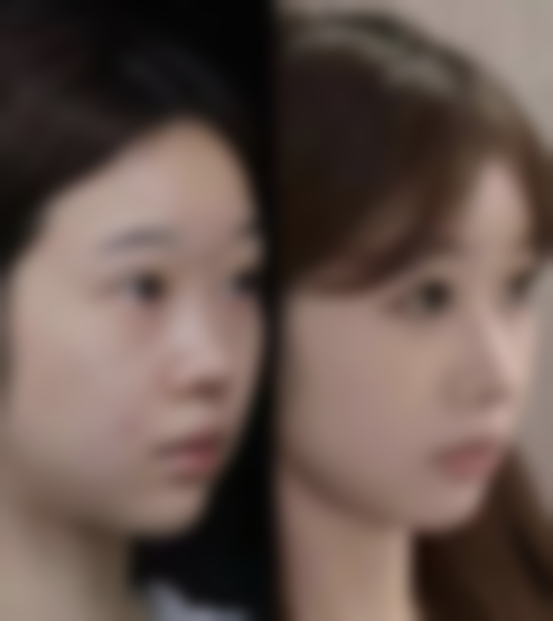 瘦脸针打几次就恒久了