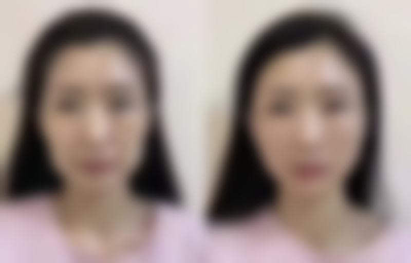 打瘦脸针有后遗症吗