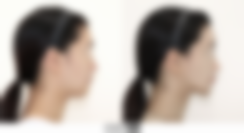 医美丰太阳穴的常见方法