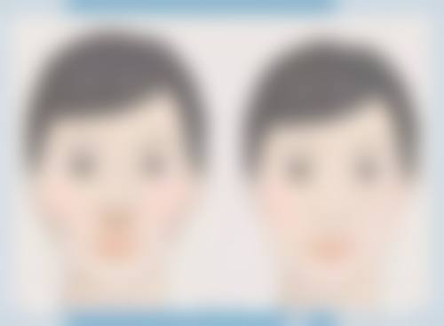 下颌角削骨手术