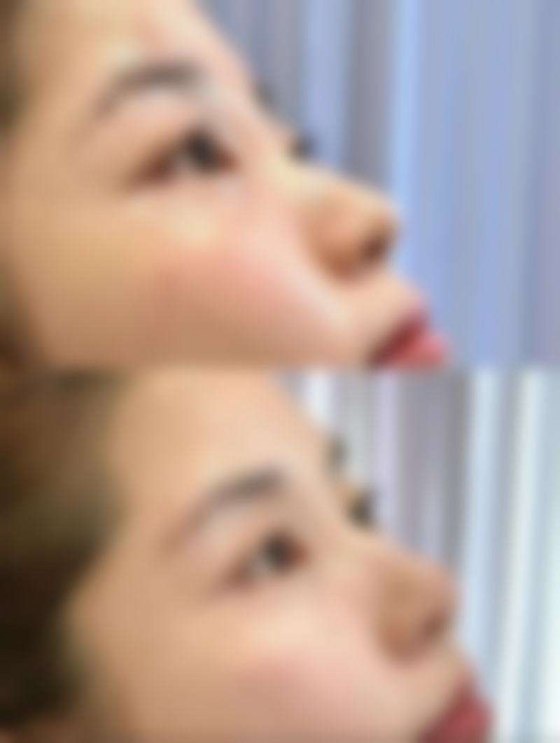 下颌角手术后头套要戴多久？