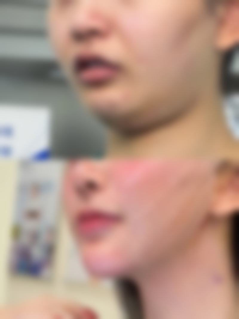 瘦脸针打完多久见效