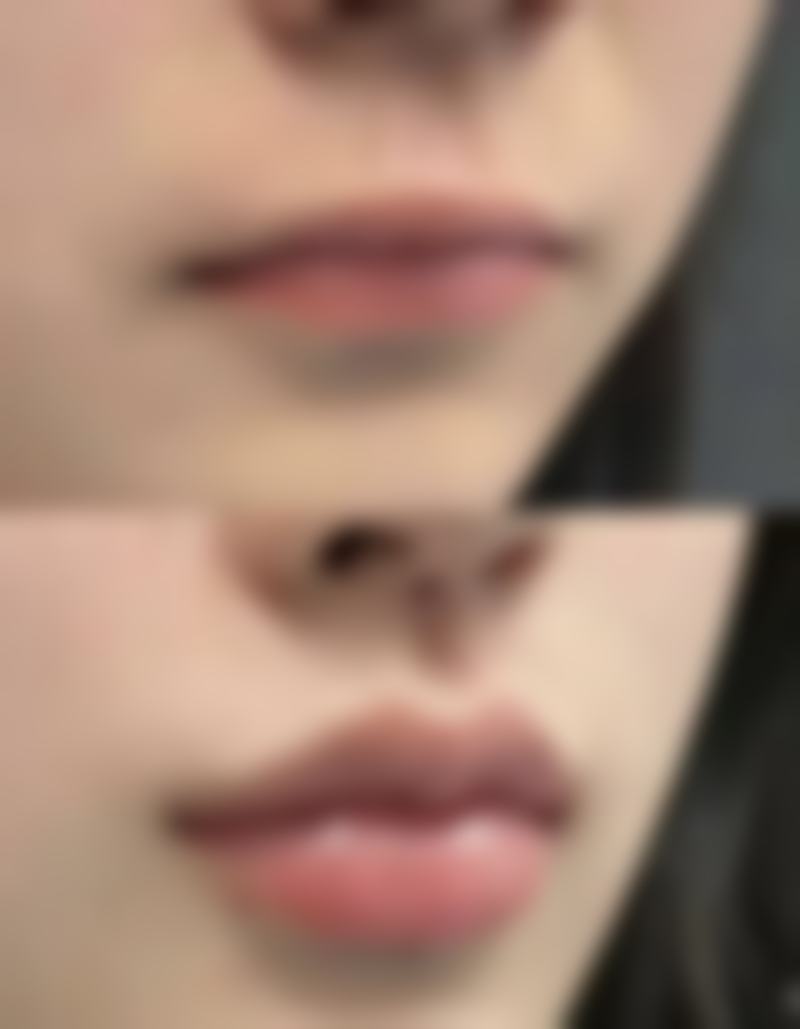 阴唇缩小术相关知识