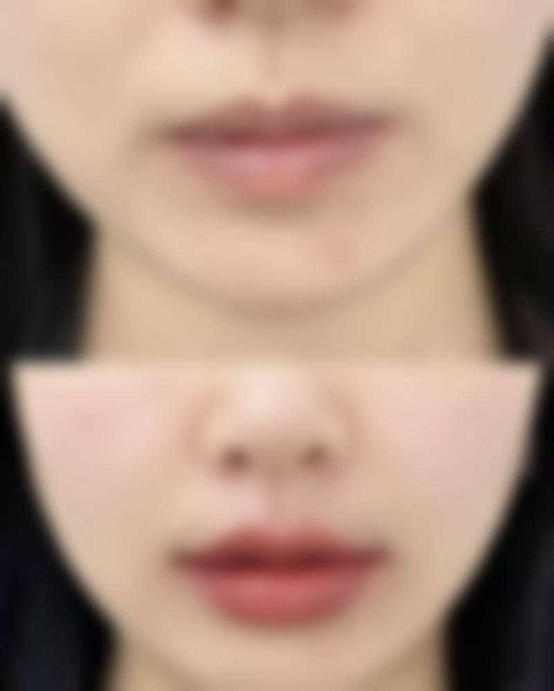 瘦脸针多久见效呢？掌握这些秘籍，最快1周显效，稳定效果3个月，助你速拥精致小脸！ 