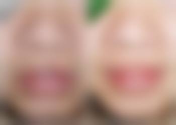 小阴唇缩小术的注意事项