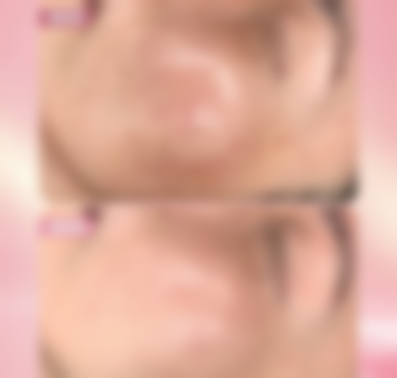 如何让瘦脸针成效更好