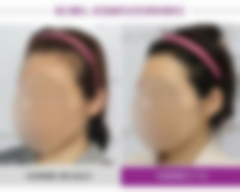 种植发际线的方法