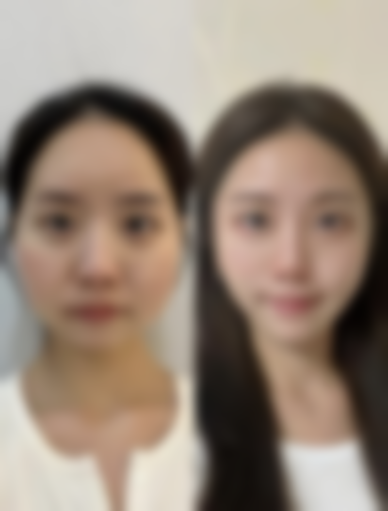 打瘦脸针后的其他注意事项