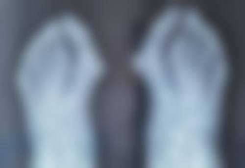 下颌骨整形失败图片能说明什么？