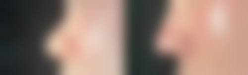 美白针常见问题解答