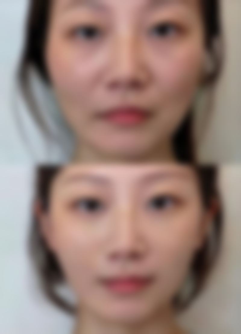 打了瘦脸针会反弹吗