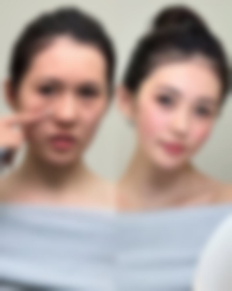 全脸打除皱针有没有什么伤害