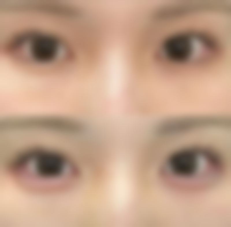 全脸能打除皱针吗女生