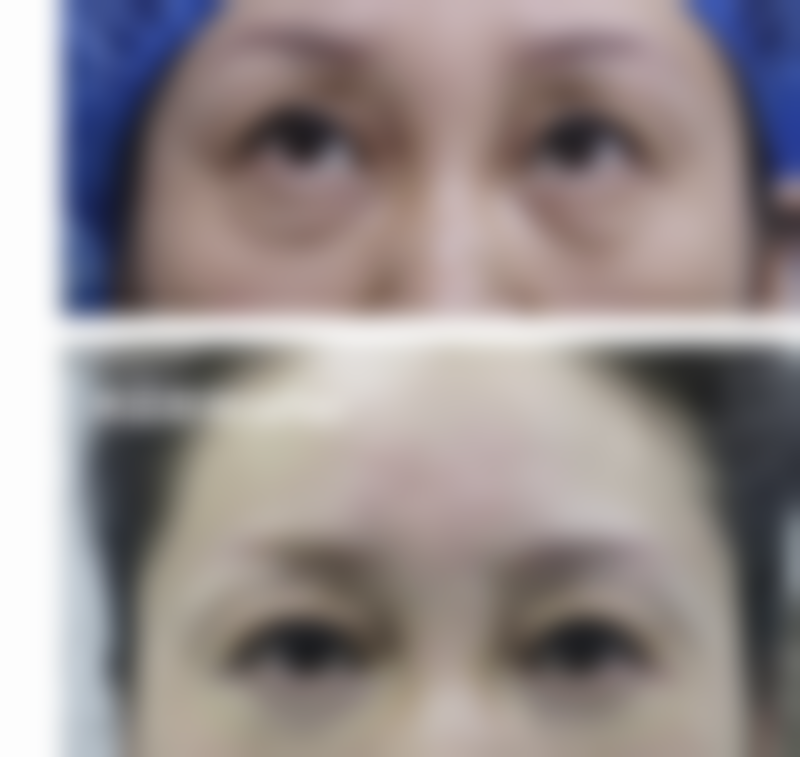 小切口除皱手术