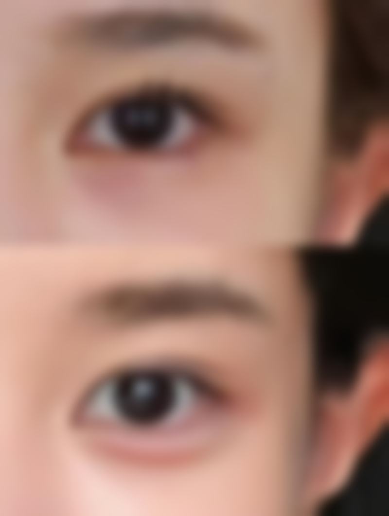 打了瘦脸针洗脸要注意什么