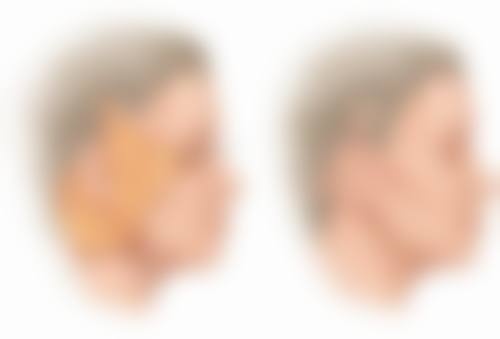 打瘦脸针后正常吃饭会影响瘦脸成效吗