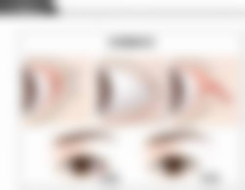 为什么不建议年轻人植发