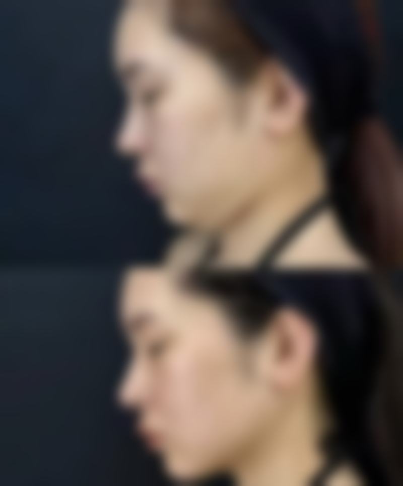 打完瘦脸针就吃饭