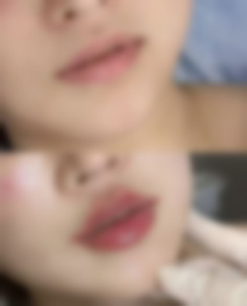 打除皱针打成了肿眼泡