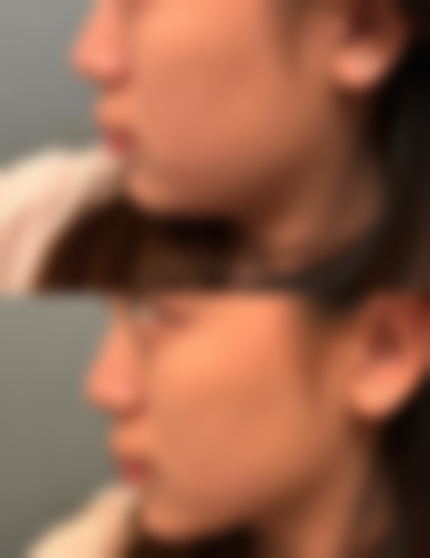 美白针能打死人吗