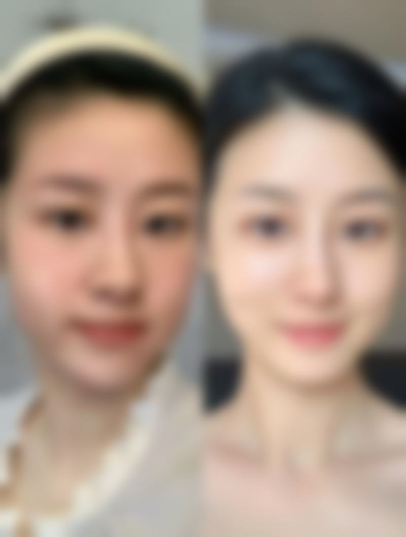 瘦脸针和水光针的成效时间