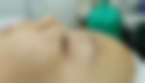 瘦脸针的见效时间