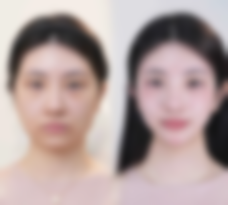 阴道紧缩手术注意事项