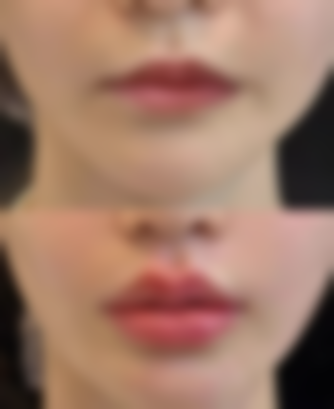 下巴整形手术全过程