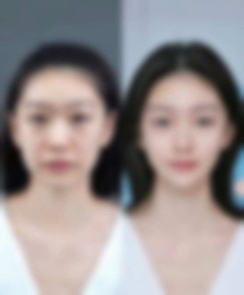 打瘦脸针抽烟了能起到什么样的后果