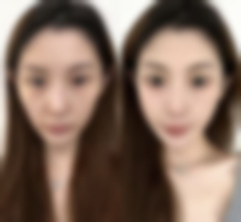 美白针什么牌子成效更好