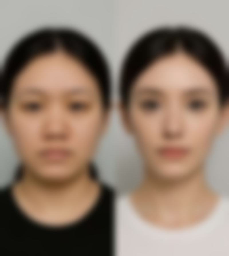 种植头发的危害和后遗症