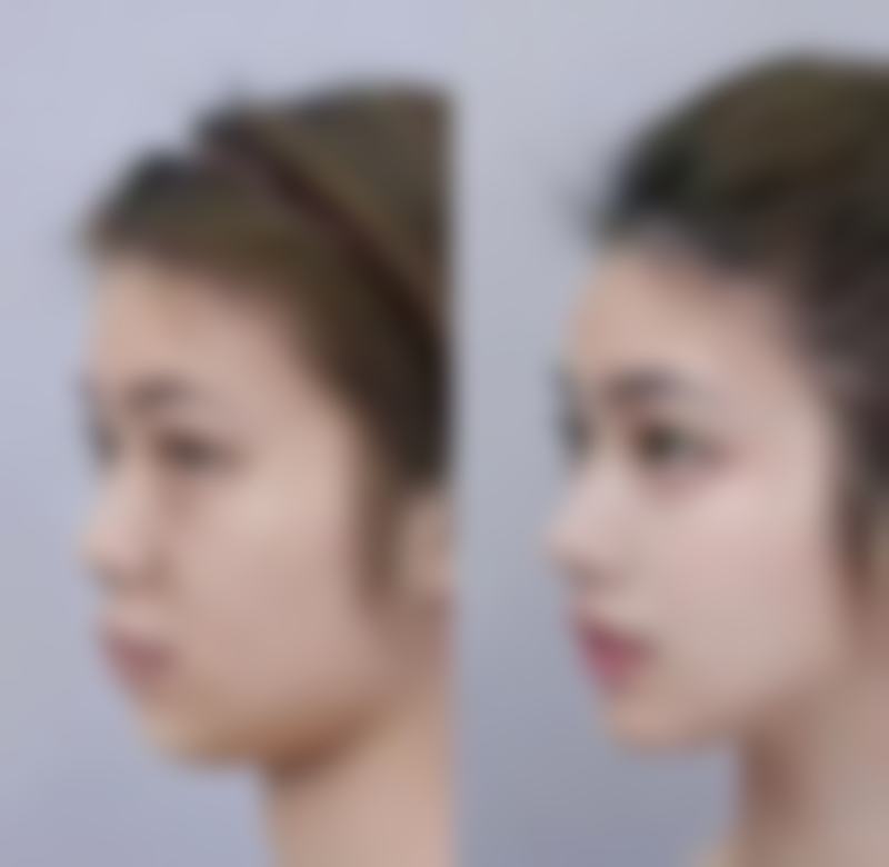 打瘦脸针蛙腮多久能消