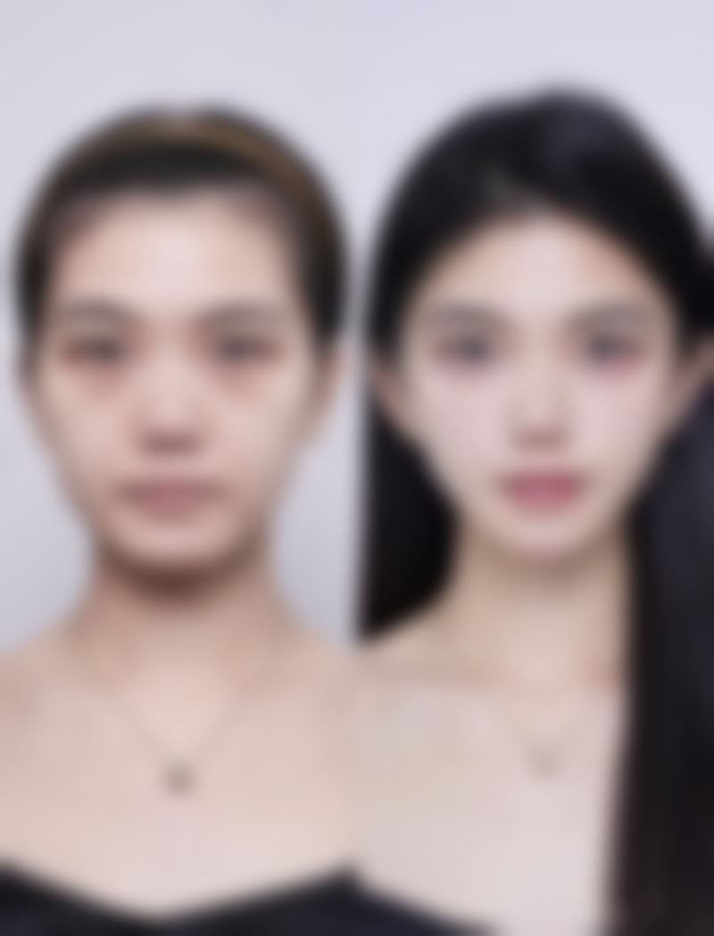 毛发种植是恒久的吗？