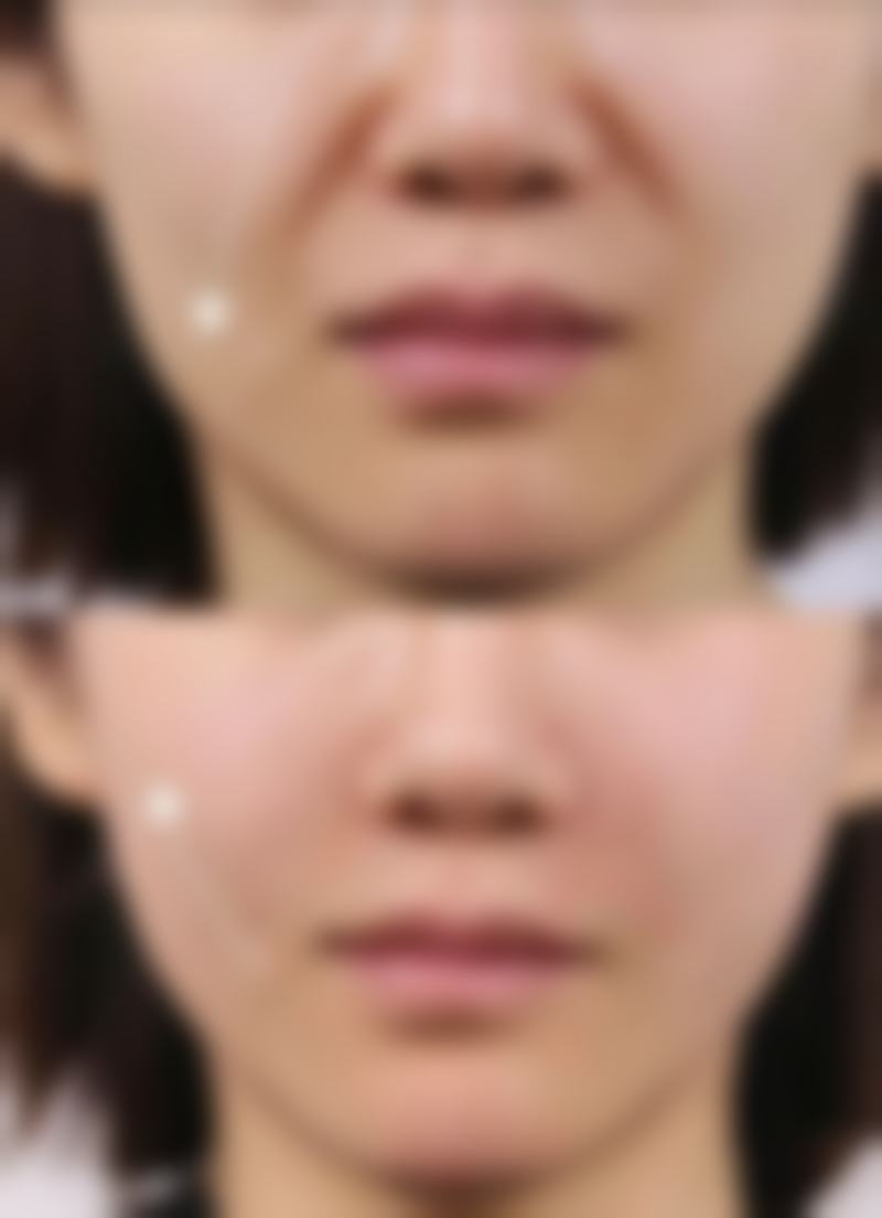 唇组织缺损的处理方法