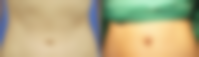 不同去皱方法的价格及适用人群