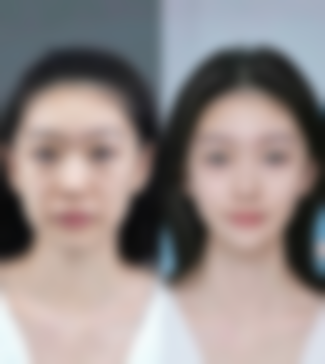 水光针微针治疗时间小时后可以正常护肤