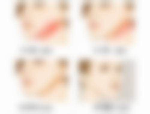 14 岁可以打肉毒素吗？